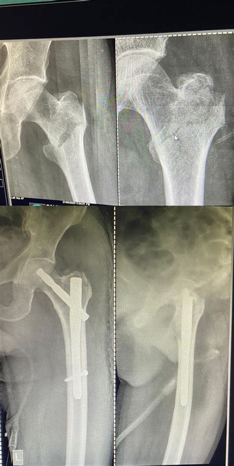 Trochanteric Femur Fracture