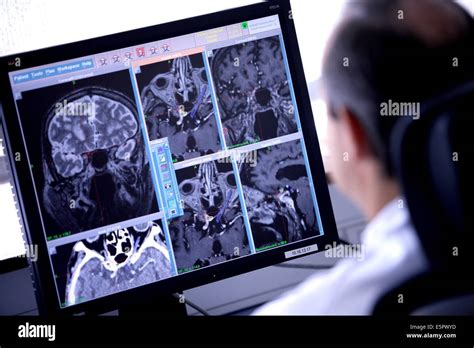 Treatment Of A Meningioma Benign Brain Tumor With A Gamma Knife Stock