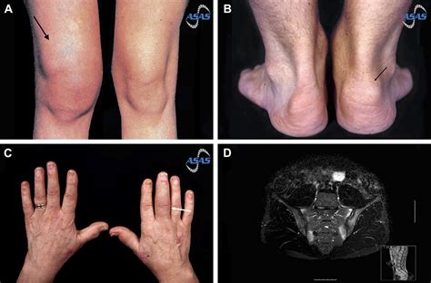 IBD And Arthropathies A Practical Approach To Its Diagnosis And