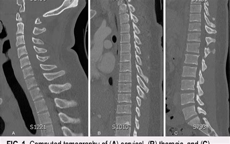 Figure From Traumatic Rupture Of Thoracic Epidural Capillary