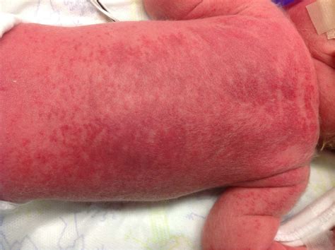 Figure 1 From Erythematous Plaques And Papules On A Premature Infant