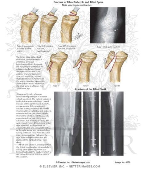 Tibial Spine Anatomy