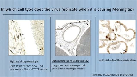 Pathology of JC Virus