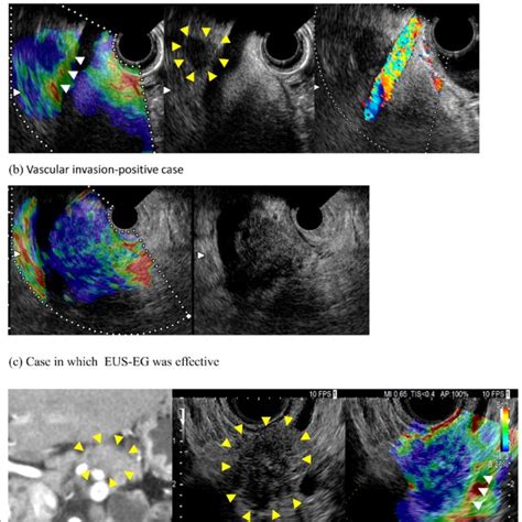 Diagnosis Of Vascular Invasion By Endoscopic Ultrasonography Download Scientific Diagram