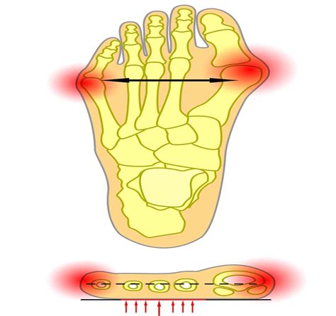 Ganglion Cyst in the Big Toe Joint [Causes, Symptoms & Best Treatment!]