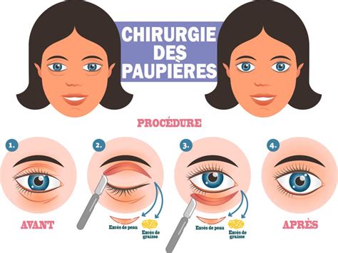 Blépharoplastie La chirurgie pour la correction des paupières