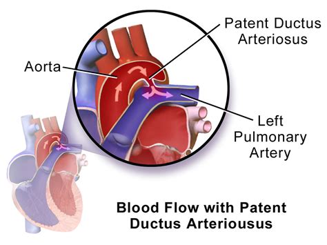 Patent Ductus Arteriosus Causes Symptoms Diagnosis Treatment