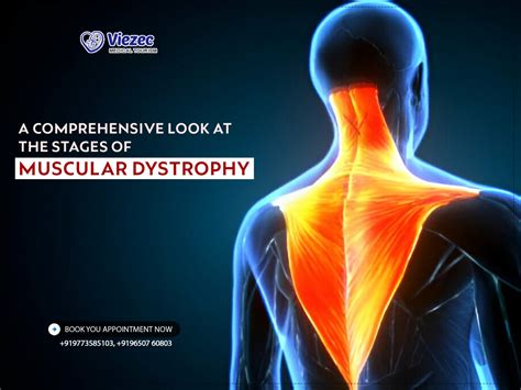 Breaking Down The Stages Of Muscular Dystrophy What To Expect