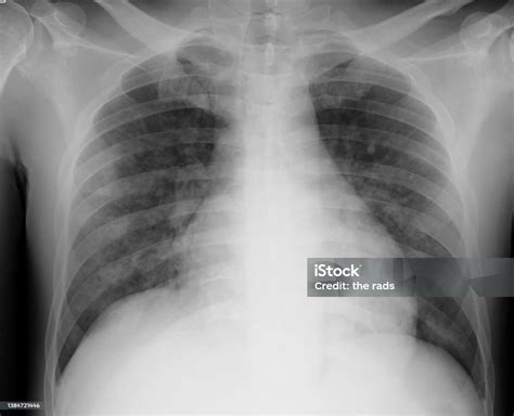 Chest X Ray Of Covid 19 Pneumonia Stock Photo - Download Image Now - Medical Scan, Adult ...