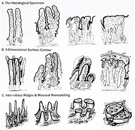 This Overview Represents Intestinal Mucosa Through Its Remodelling