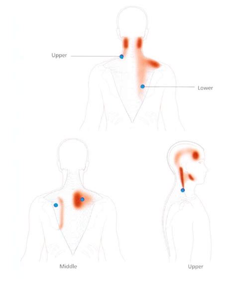 Acupuncture For Trigger Points — Morningside Acupuncture Nyc