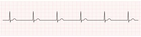 Ekg Monitor Showing Junctional Escape Rhythm Vector Art At