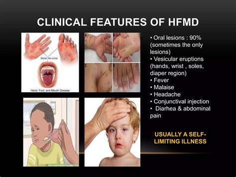 Hand foot-mouth disease (hfmd) | PDF