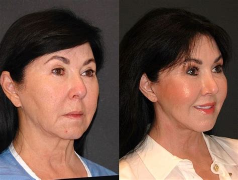 Best Deep Plane Facelifting Results Mini Face Lift Facelift Before And