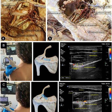 A Photograph Of The Superior Margin Of Scapula Posterior View A