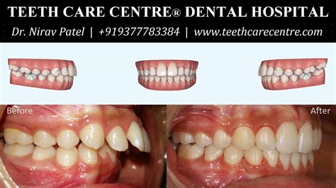 Invisalign Before And After Lower Jaw Advancement Youtube