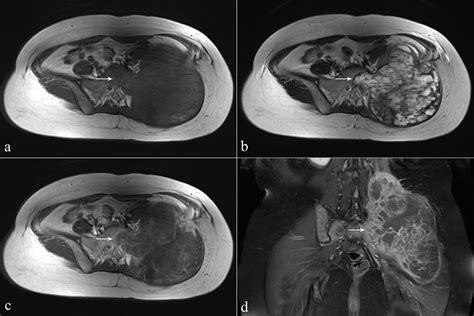 A 36 Year Old Female With Giant Bone Cell Tumor Of The Left Ilium Download Scientific Diagram