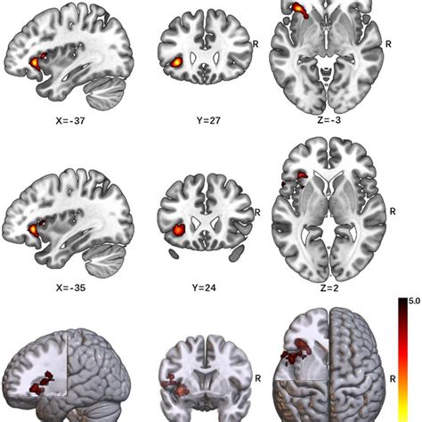 Significant Cerebellum Region In VBM Analysis GMV Of The Cerebellum