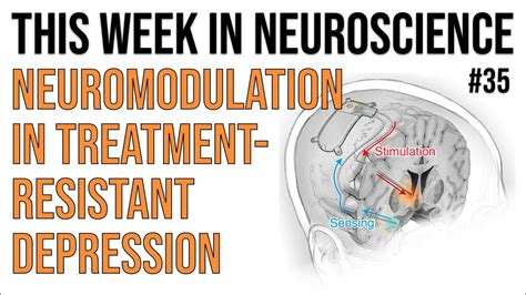 Twin 35 Neuromodulation In Treatment Resistant Depression Youtube