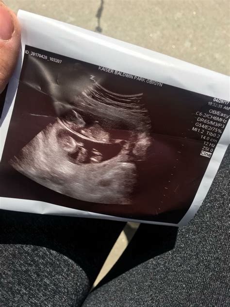 35 Weeks Pregnant With Twins Ultrasound