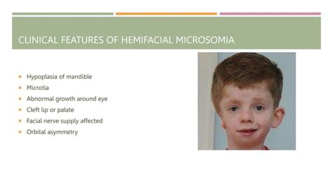 micrognathic syndromes affecting oral cavity | PPT