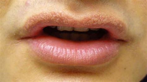 Puntitos blancos en los labios genitales causas síntomas y