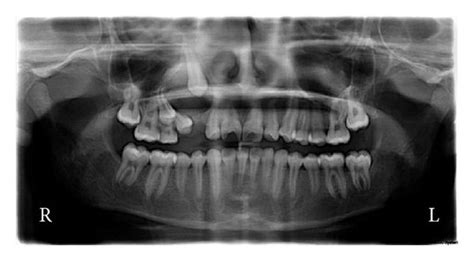Preoperative Orthopantomograph Showing Radiolucent Lesion In Relation