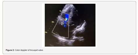 Carcinoid Heart Metastasis With Pericardial Effusion A Rare