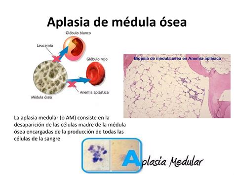 Aplasia De Medula - Insuficiencia de la medula osea - Hematologia | PPTX