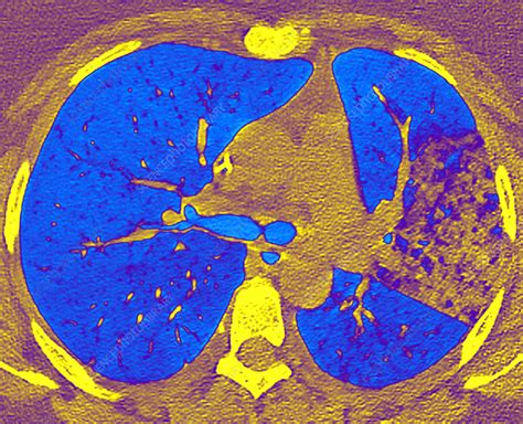 Bacterial pneumonia, CT scan - Stock Image - C048/2979 - Science Photo Library