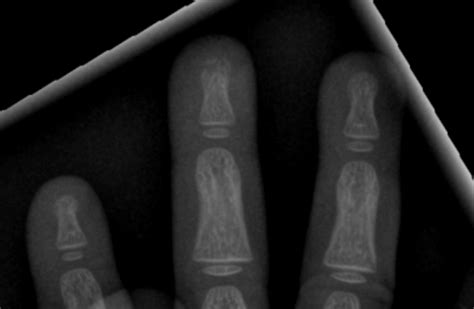 Phalangeal Tuft Fracture Radiology Case Radshare Net