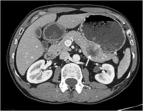 Abdominal Enhanced Computed Tomography Showing A Solido Cystic Mass