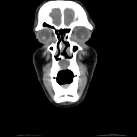 Nasopalatine duct cyst | Radiology Case | Radiopaedia.org