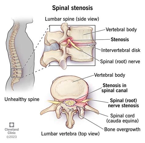 Lumbar Spinal Stenosis Treatment Option