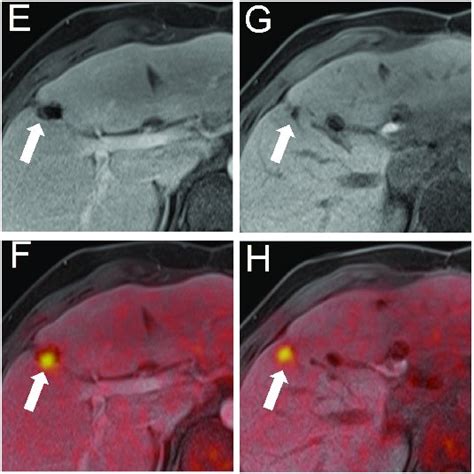 A 25 Year Old Female Patient With A History Of Colorectal Cancer