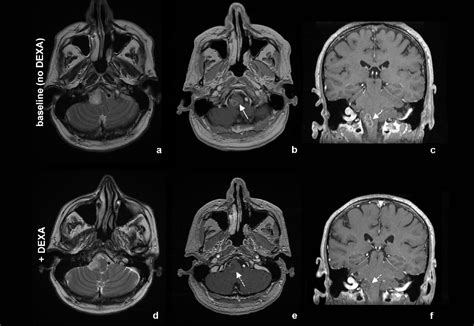 Figure 1 From Imaging Characterization Of An Adult H3 K27m Altered