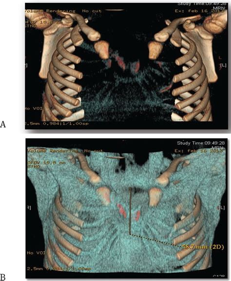 Three Dimensional Reconstruction Of Ct Images Showed The Presence Of A