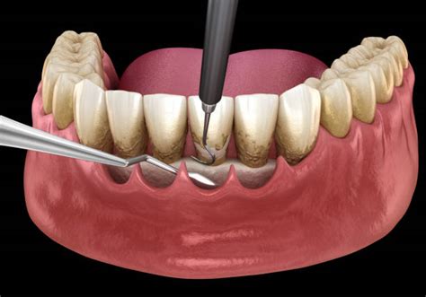 Receding Gums Treatment Prevention For A Healthy Smile