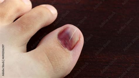 Runners Toe Or Subungual Hematoma After Toenail Trauma Bruise Under