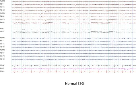 Creutzfeldt Jakob Disease Eeg