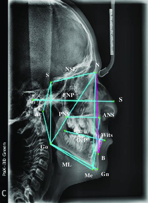 Figure Landmarks Used For The Cephalometric Analysis Download Scientific Diagram