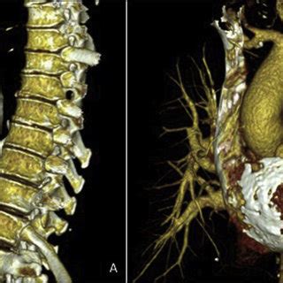 A Three Dimensional CT Reconstruction Showing Extensive