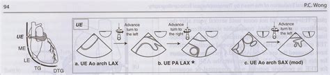 Pedi cardiology: TEE - Basic Views & terminology