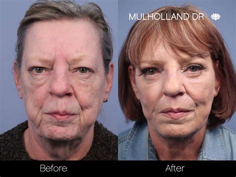 Non Surgical Facelifts Before And After | Pea-vie