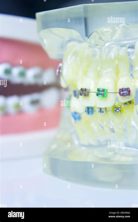 model denture  metal orthodontics  people stock photo alamy