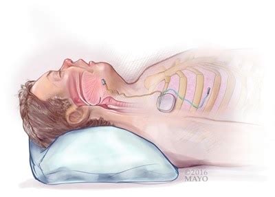 Treating Sleep Apnea Made Easier Upper Airway Stimulation Therapy