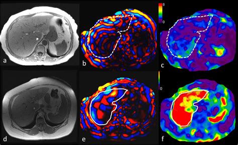 Mr Elastography In Two Patients With Nafld Top Row A Year Old