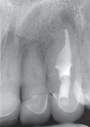 Six Month Follow Up Radiograph Of The Maxillary Left Canine Showing