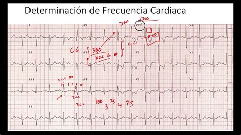 Método 2 Frecuencia Exacta Determinación Frecuencia Cardiaca Ekg Youtube