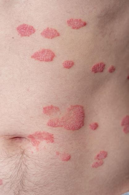 Las Manchas Cut Neas De La Psoriasis Vulgaris Suelen Ser Rojas Con